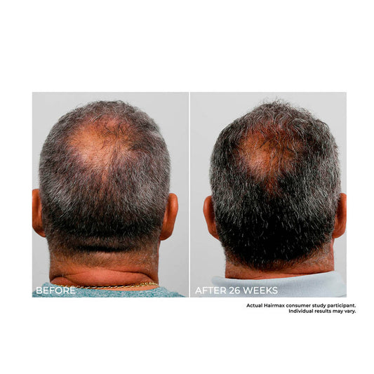 BodyEase Haarstimulerend Kam — Meer Volume en Dikker Haar